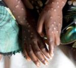 Mpox in Africa: New strain declared a continental public health emergency