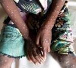 WHO declares Mpox global health emergency