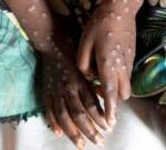 Mpox: Travellers advised to consider vaccine