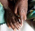 Mpox not new Covid and can be stopped, expert says