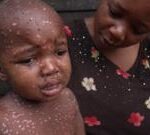 Mpox in DR Congo: The children who are suffering the most