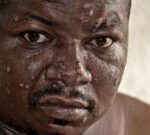 Mpox in Burundi: On the frontline of the fight to halt the spread