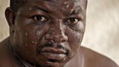 Mpox in Burundi: On the frontline of the fight to halt the spread