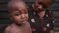 Mpox in DR Congo: The children who are suffering the most