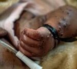 Mpox in DR Congo: Medics plead for vaccines as rate of infections increases