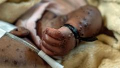 Mpox in DR Congo: Medics plead for vaccines as rate of infections increases